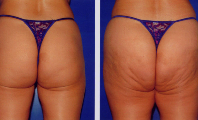 cómo eliminar la celulitis