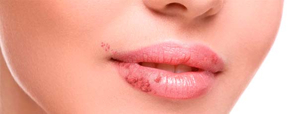 curar el herpes