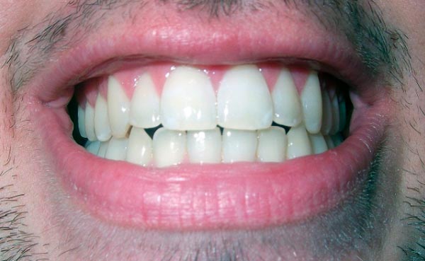 implantes dentales en Pineda de Mar