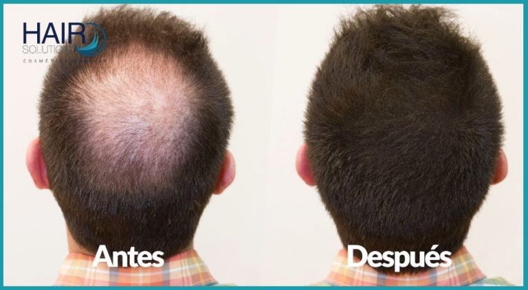 hair solution