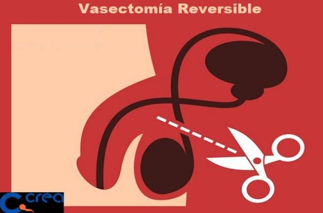 vasectomía reversible
