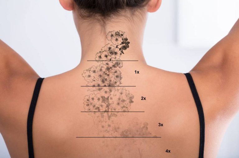 eliminar un tatuaje de forma segura