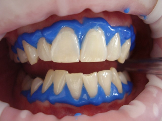 blanqueamiento dental