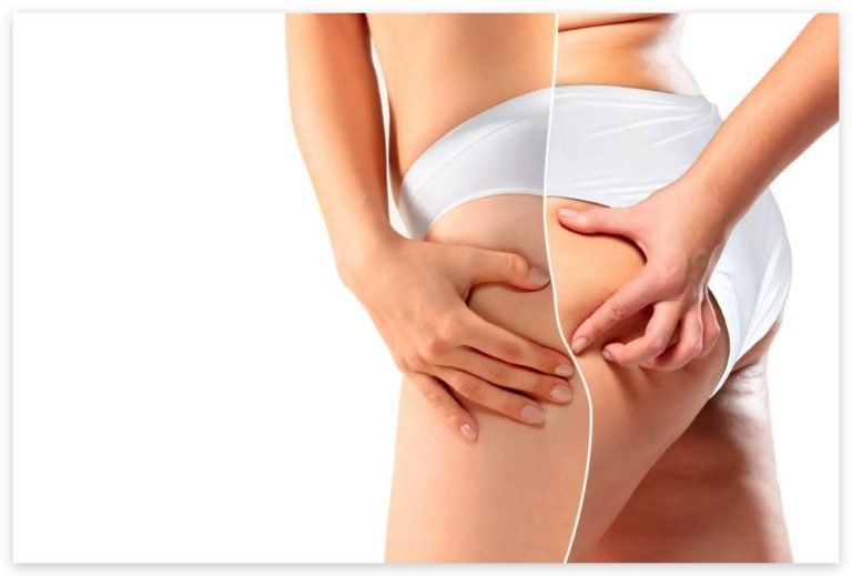 evolución del lipedema